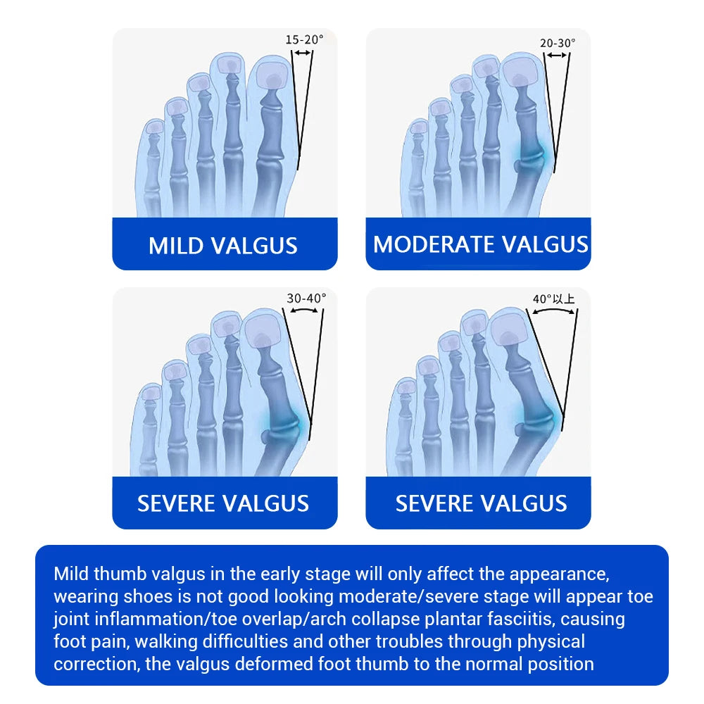 Unisex Bunion Foot Adjuster Rotating Knob Hallux Valgus Splint Big Toe Straightener Brace with Heel Strap for Left Right Foot